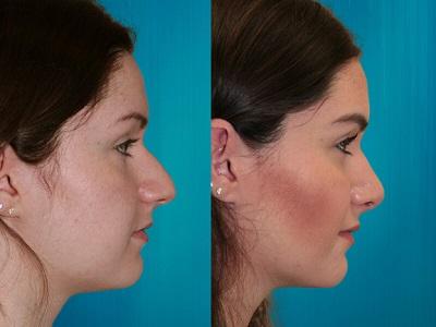 rhinoplastie combinée à une chirurgie menton